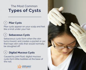 types of cysts | Epiphany Dermatology