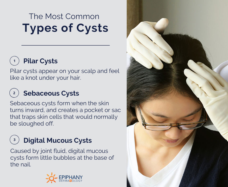 self removal of sebaceous cyst