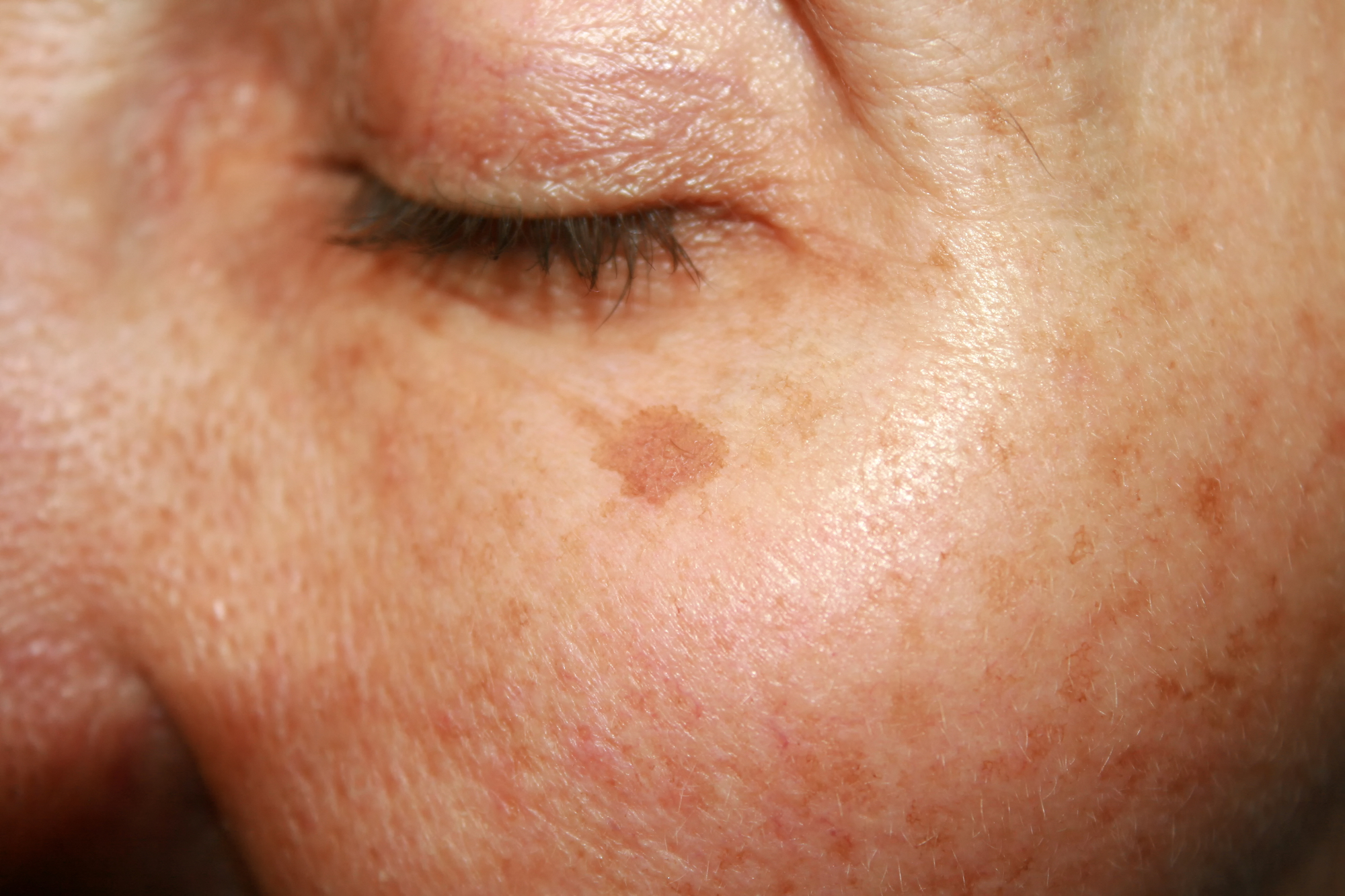 Age/Brown Spot Removal, Intense Pulsed Light - IPL