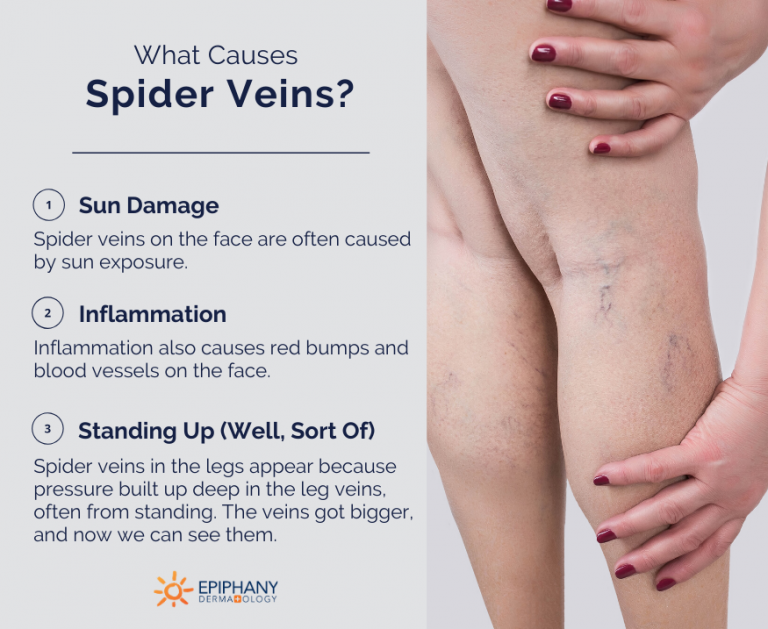 How To Get Rid Of Spider Veins On Your Legs Face And Feet 9509