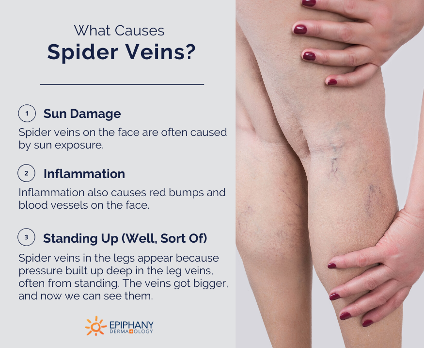 How to Get Rid of Spider Veins on Your Legs, Face, & Feet