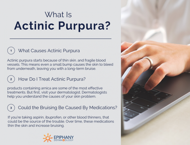 Unexplained Bruising on Your Arms? It Might Be Actinic Purpura