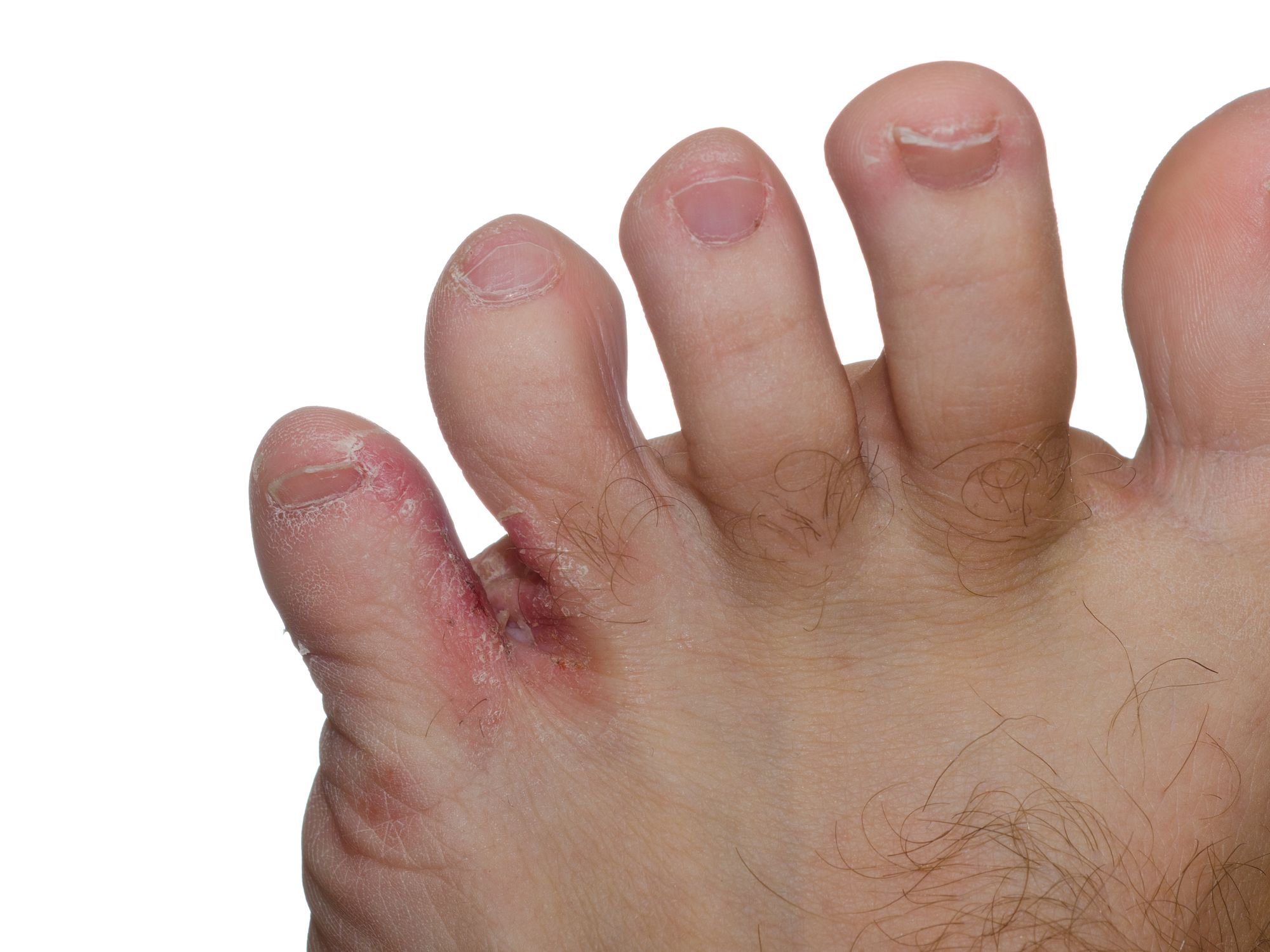 Common Fungal Infections Athlete s Foot Epiphany Dermatology