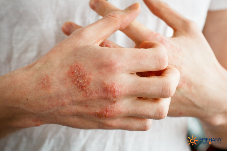 red-scaly-rash-here-s-why-you-need-a-dermatologist-to-diagnose-you