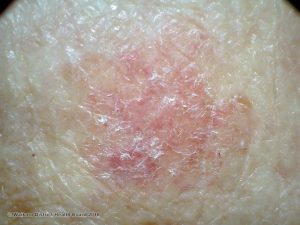 Red, Scaly Rash? Here's Why You Need A Dermatologist to Diagnose You