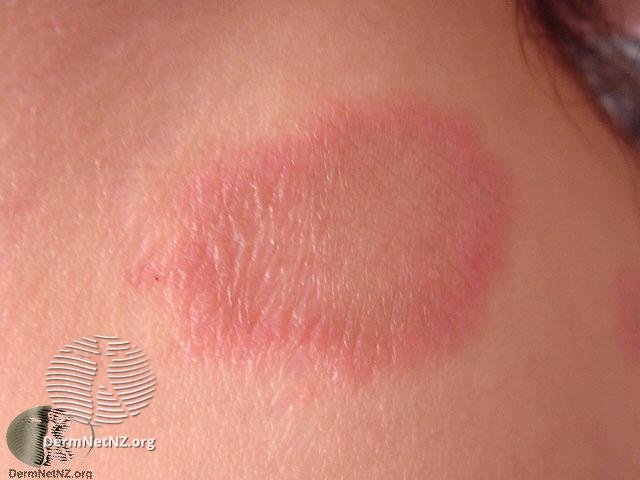 Red Scaly Rash Here s Why You Need A Dermatologist To Diagnose You