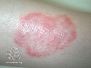 tinea-corporis | Epiphany Dermatology