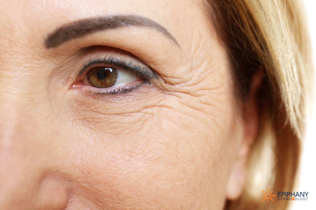How To Get Rid Of Eye Lines, Creases & Wrinkles