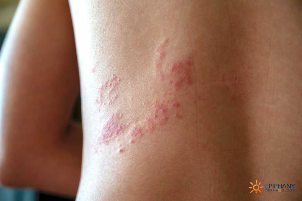 does shingles itch