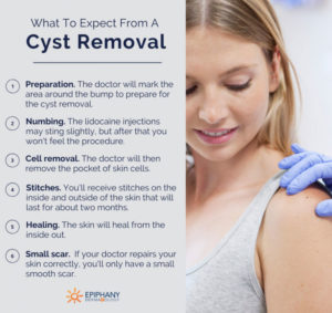 What to Expect From A Cyst Removal | The Best Cyst Removal Treatment