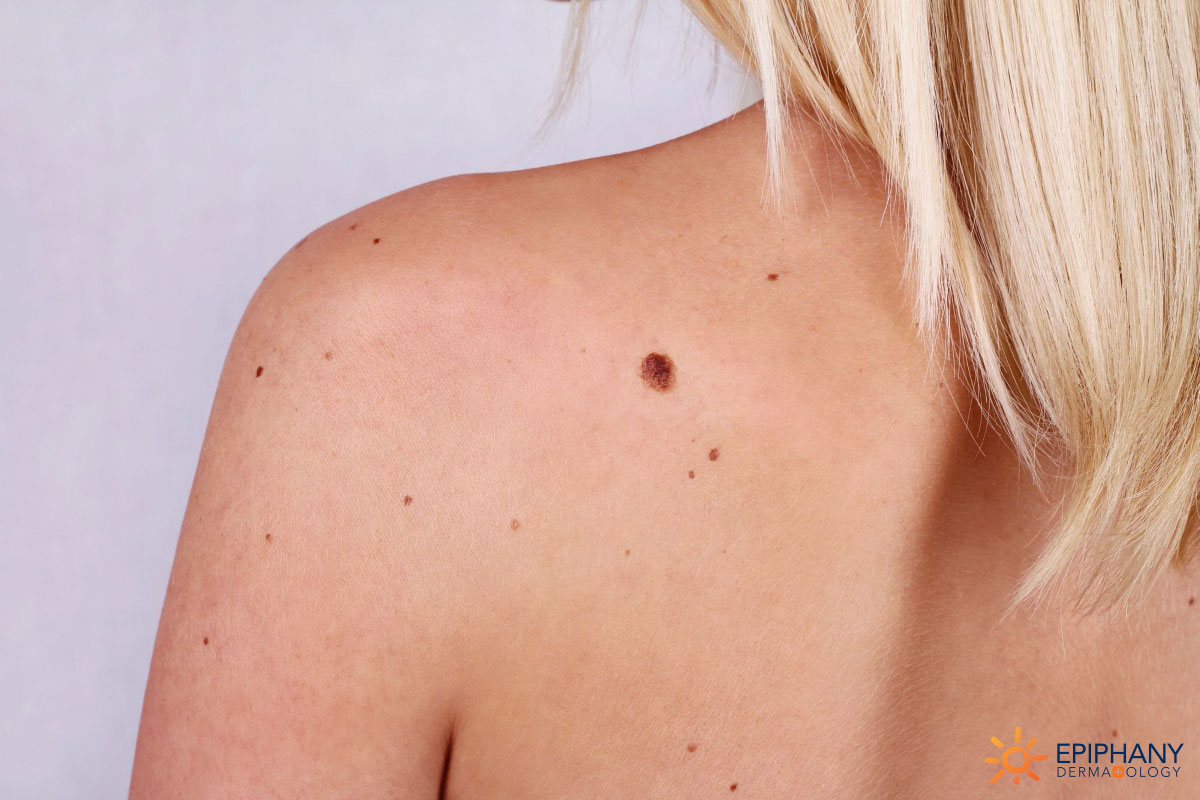 Moles and What They Say About You 