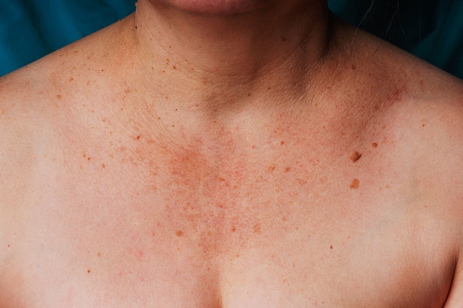 white-spots-on-skin-from-sun